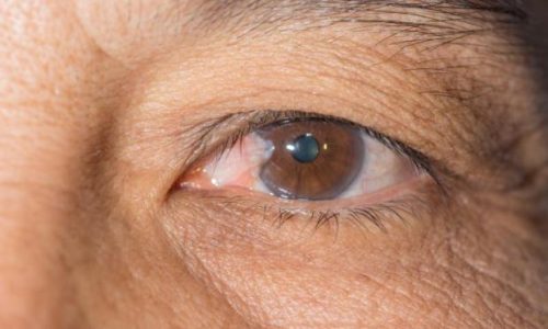 Ocular Hypertension Can Make You Blind. Try Careprost 3ml.
