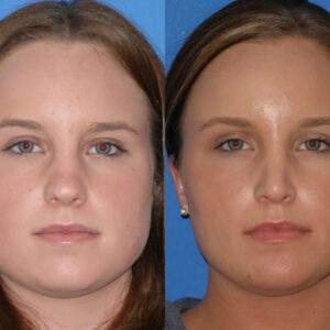 Compelling Reasons for Jawline Slimming Botox