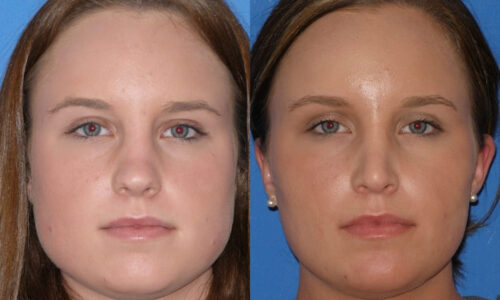 Compelling Reasons for Jawline Slimming Botox
