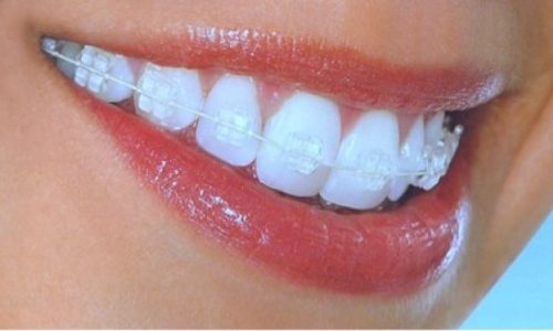 Invisalign Clear Braces: To Consider Or Not?