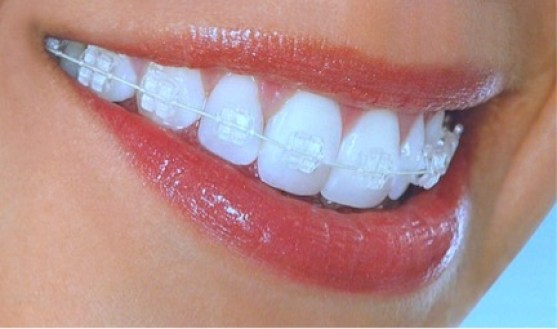 Invisalign Clear Braces: To Consider Or Not?