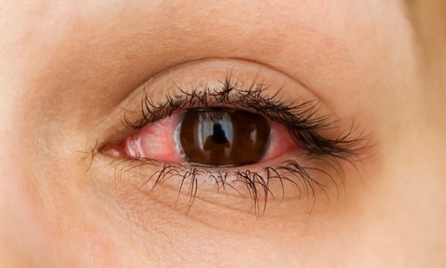 How to Look After Your Eyes When You Wear Contact Lenses