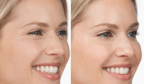 How Long Does Botox Work For?