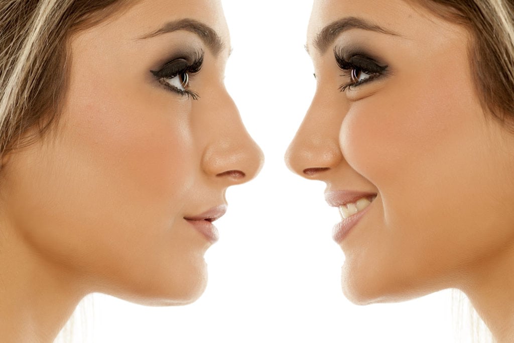 Let's Set the Record Straight About Nose Jobs