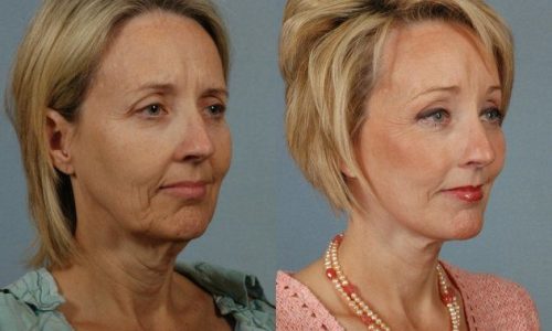 How Permanent Are The Results of a Facelift?