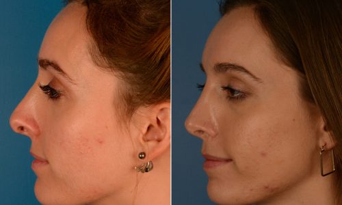 Why Should You Get A Revision Rhinoplasty?